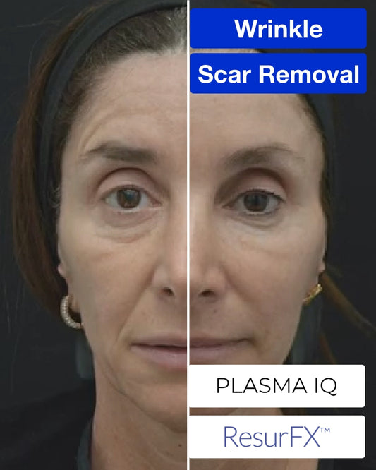 Service Voucher - Two (2) ResurFX Treatments + One (1) Plasma IQ 30-mins Session Treatment