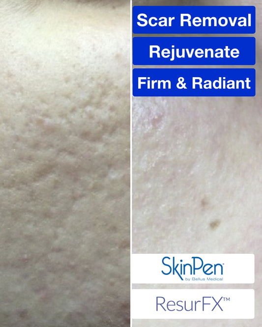 Six (6) ResurFX Treatments & One (1) SkinPen Session (Full Face) w/ Stem Cell + FREE Hydrinity Restorative Mask & Post Procedure Kit ($156 Value)