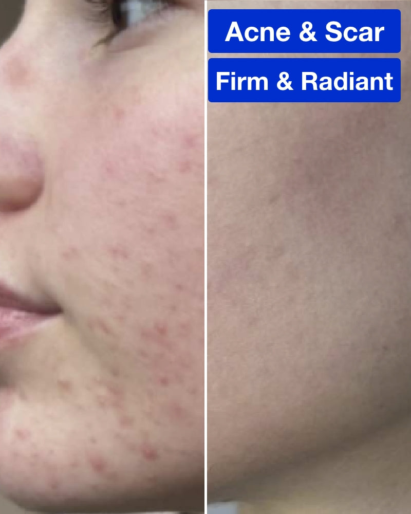 Six (6) ResurFX Treatments & One (1) SkinPen Session (Full Face) w/ Stem Cell + FREE Hydrinity Restorative Mask & Post Procedure Kit ($156 Value)