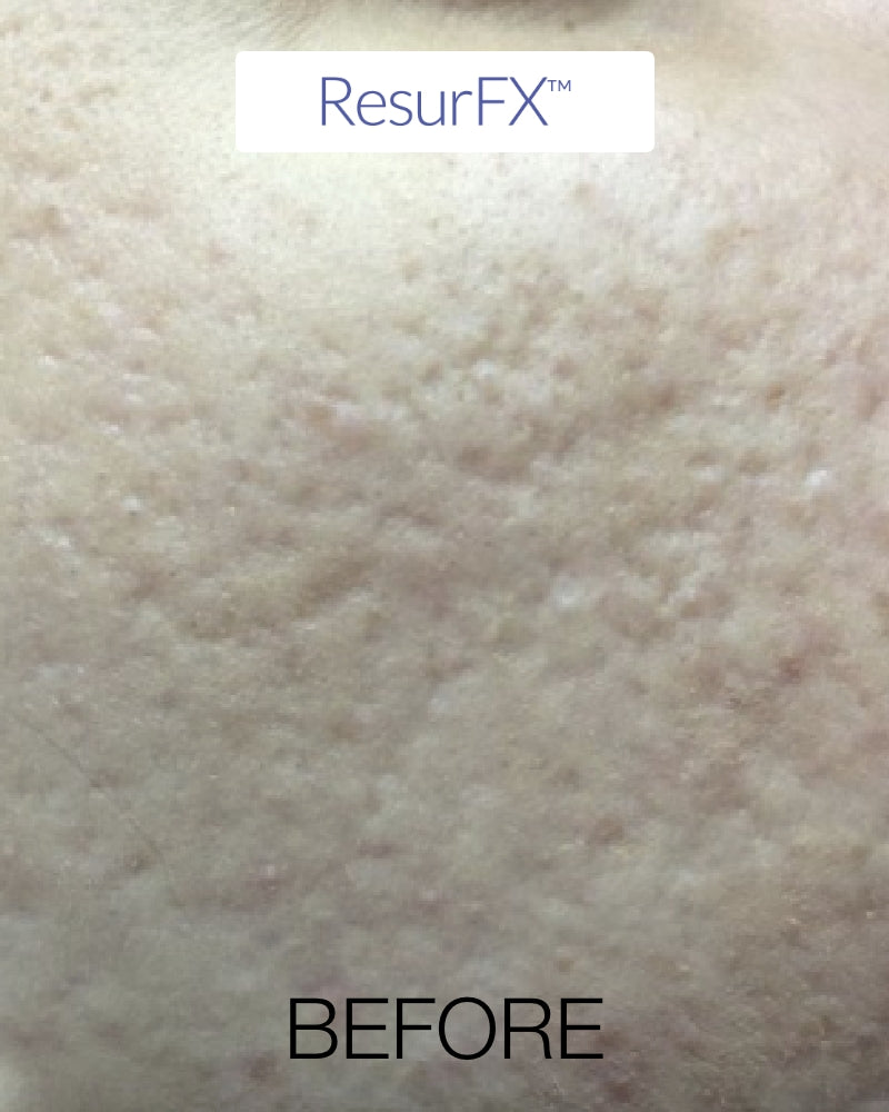 Six (6) ResurFX Treatments & One (1) SkinPen Session (Full Face) w/ Stem Cell + FREE Hydrinity Restorative Mask & Post Procedure Kit ($156 Value)