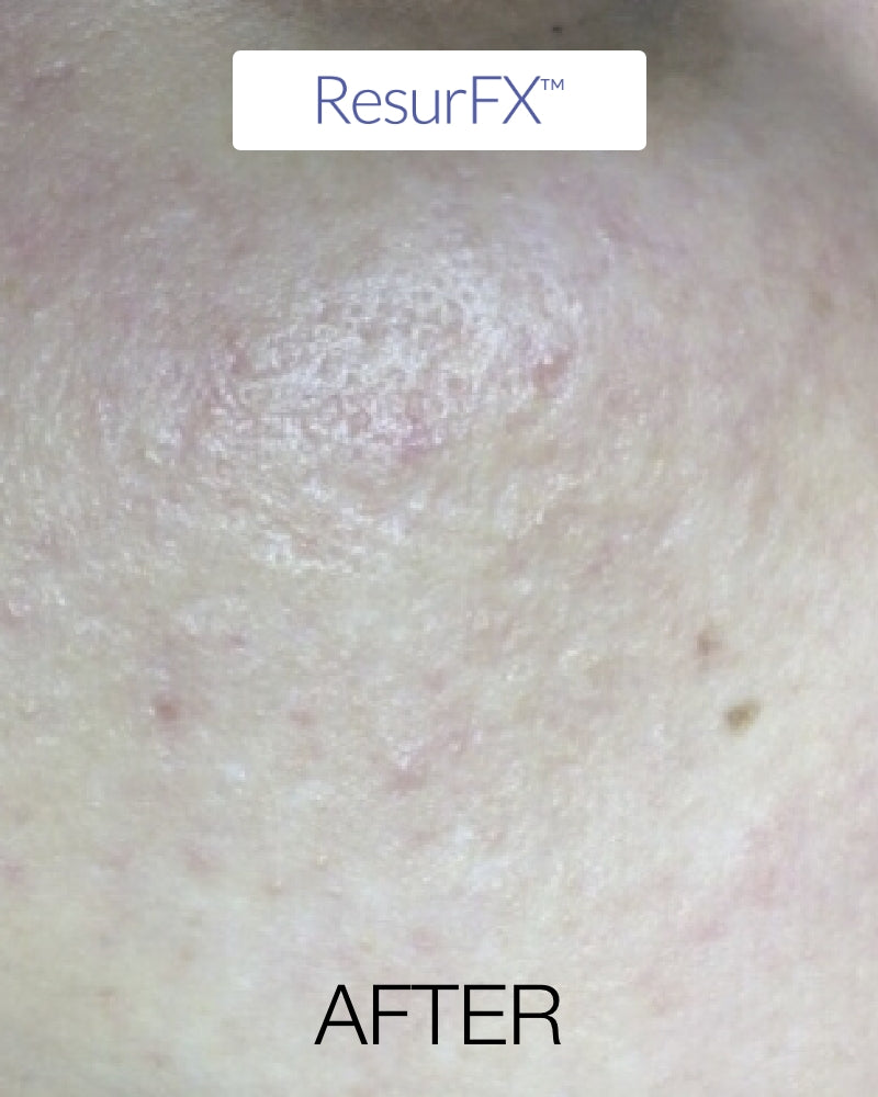 Six (6) ResurFX Treatments & One (1) SkinPen Session (Full Face) w/ Stem Cell + FREE Hydrinity Restorative Mask & Post Procedure Kit ($156 Value)