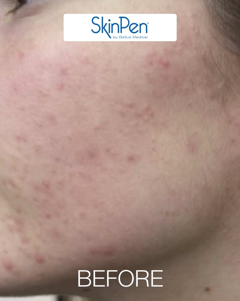 Six (6) ResurFX Treatments & One (1) SkinPen Session (Full Face) w/ Stem Cell + FREE Hydrinity Restorative Mask & Post Procedure Kit ($156 Value)