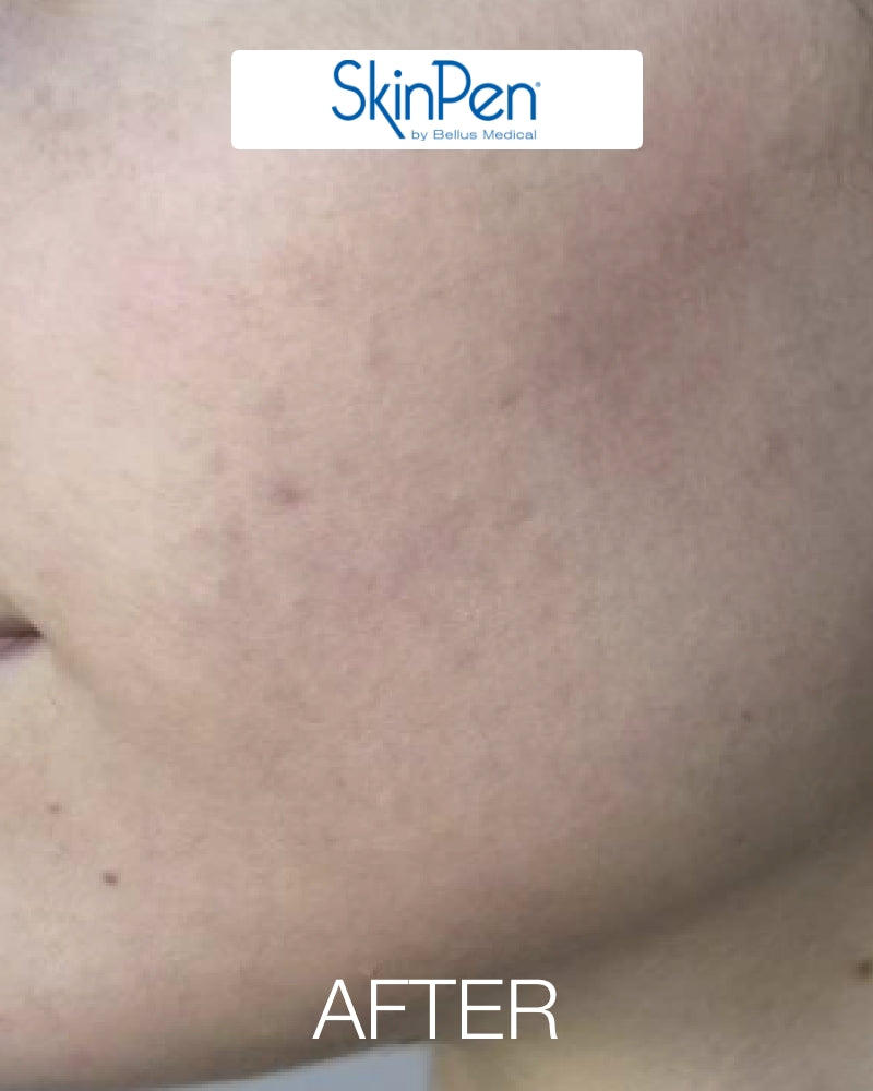 Six (6) ResurFX Treatments & One (1) SkinPen Session (Full Face) w/ Stem Cell + FREE Hydrinity Restorative Mask & Post Procedure Kit ($156 Value)
