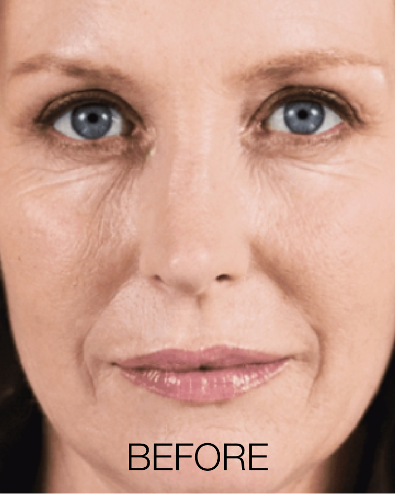 Service Voucher - 2 Vials of Sculptra + One (1) Free Full Face HydraFacial Treatment