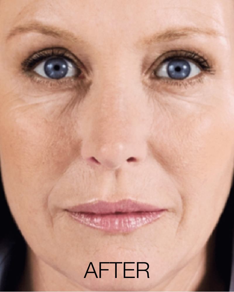 Service Voucher - 2 Vials of Sculptra + One (1) Free Full Face HydraFacial Treatment