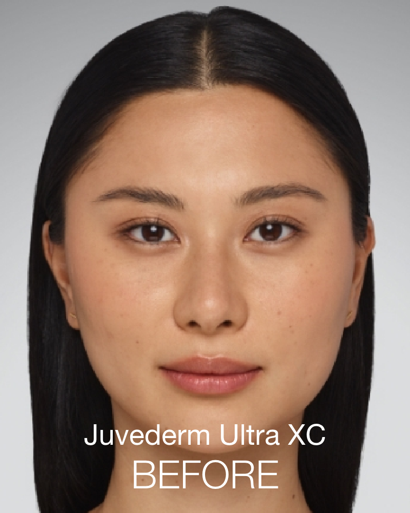 Service Voucher - Self-Love Package: 40 Units of Botox & 2 Syringes of Juvederm Ultra XC