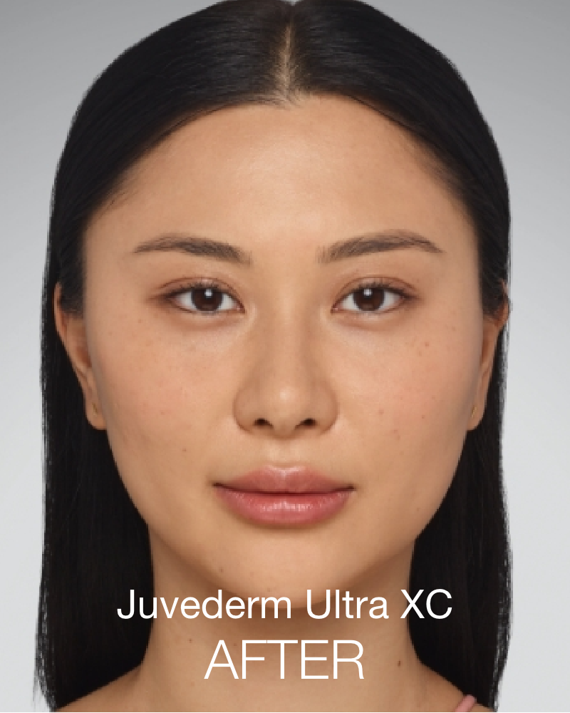 Service Voucher - Self-Love Package: 40 Units of Botox & 2 Syringes of Juvederm Ultra XC