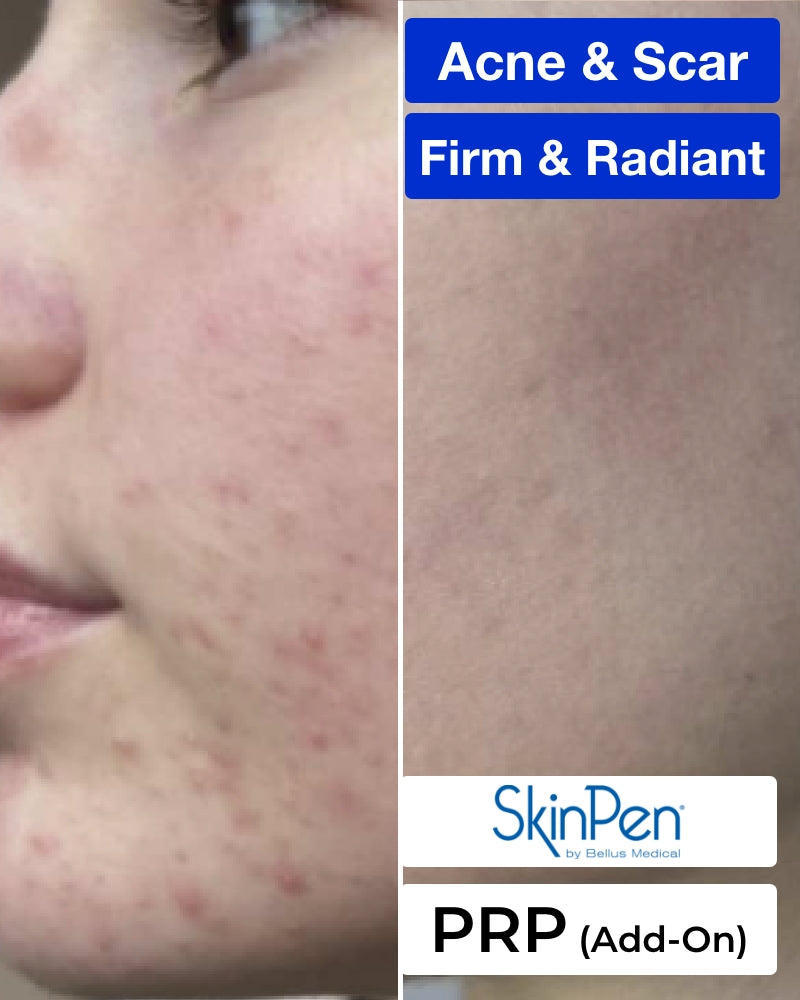 One (1) SkinPen Microneedling Treatment (Full Face) + PRP