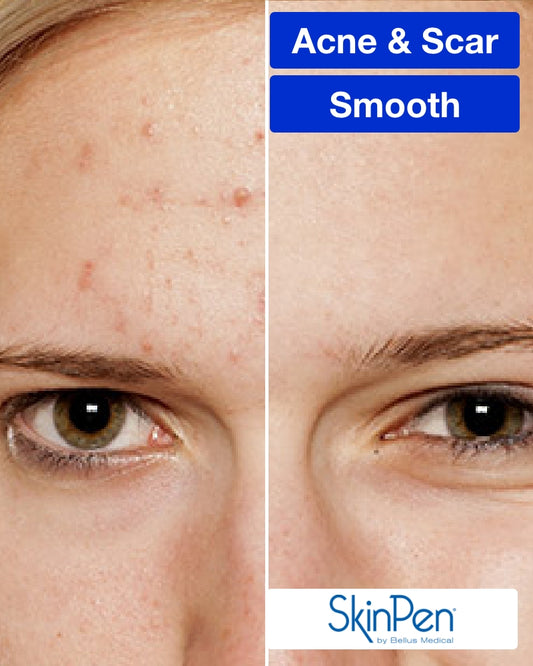 Three (3) SkinPen Microneedling Treatments (Full Face)