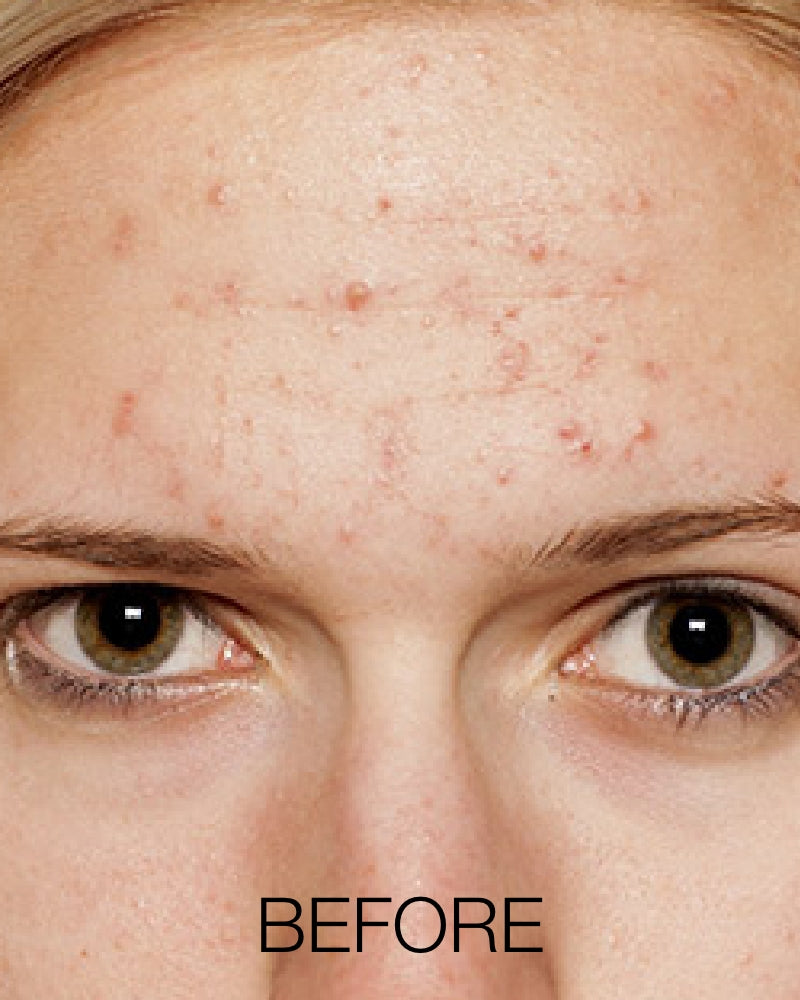 Three (3) SkinPen Microneedling Treatments (Full Face)