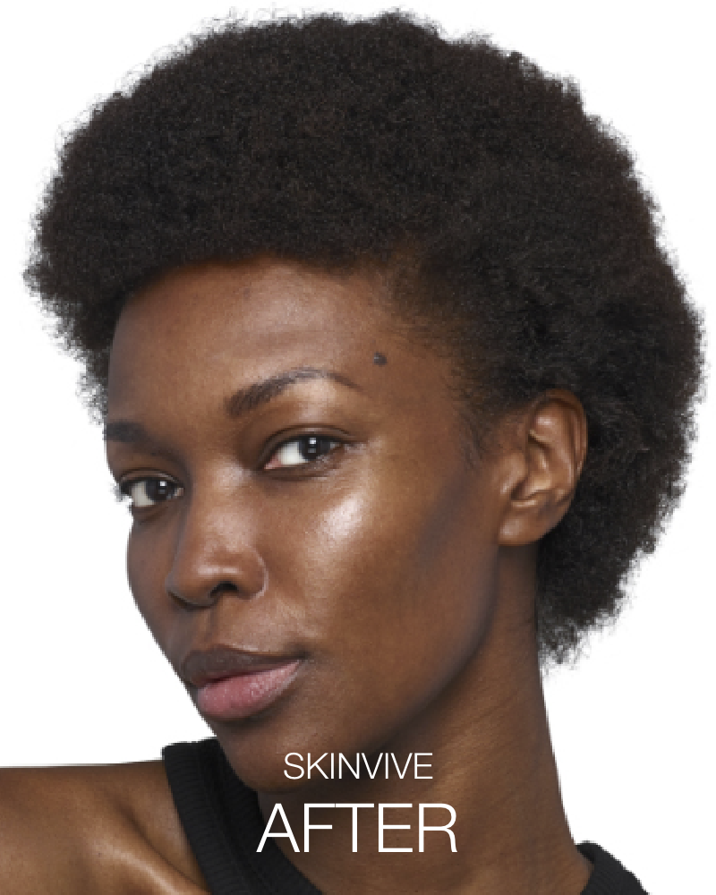 Service Voucher - Glass Skin Package: 2 Syringes of SKINVIVE & 44 Units of Botox