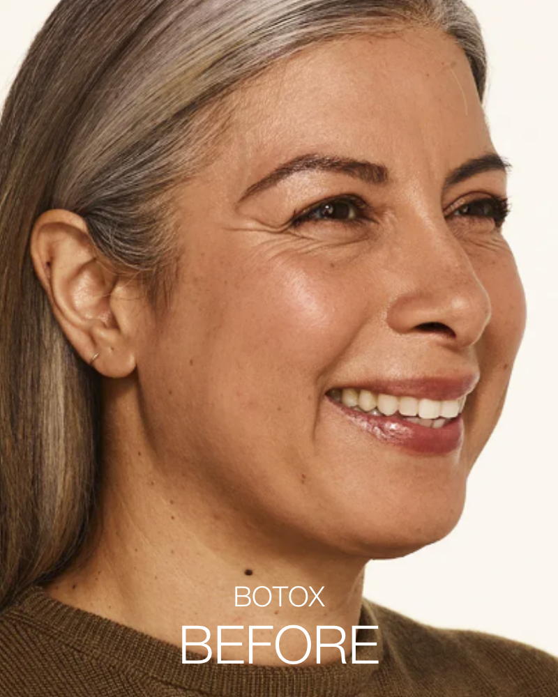Service Voucher - Glass Skin Package: 2 Syringes of SKINVIVE & 44 Units of Botox