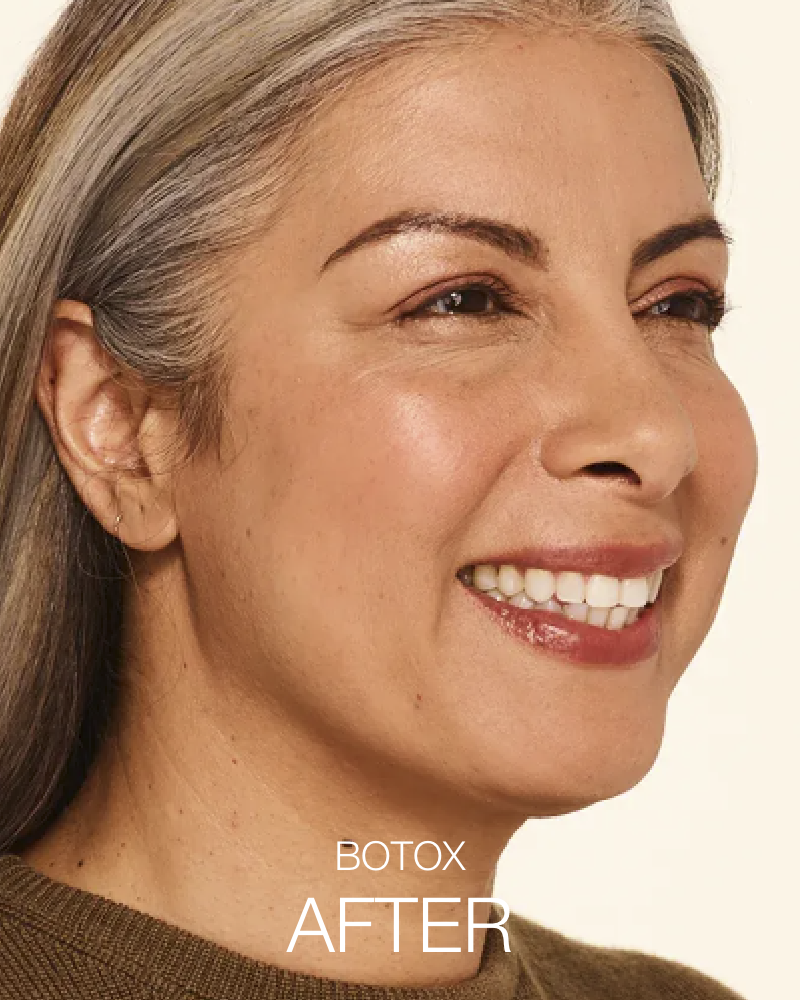 Service Voucher - Glass Skin Package: 2 Syringes of SKINVIVE & 44 Units of Botox