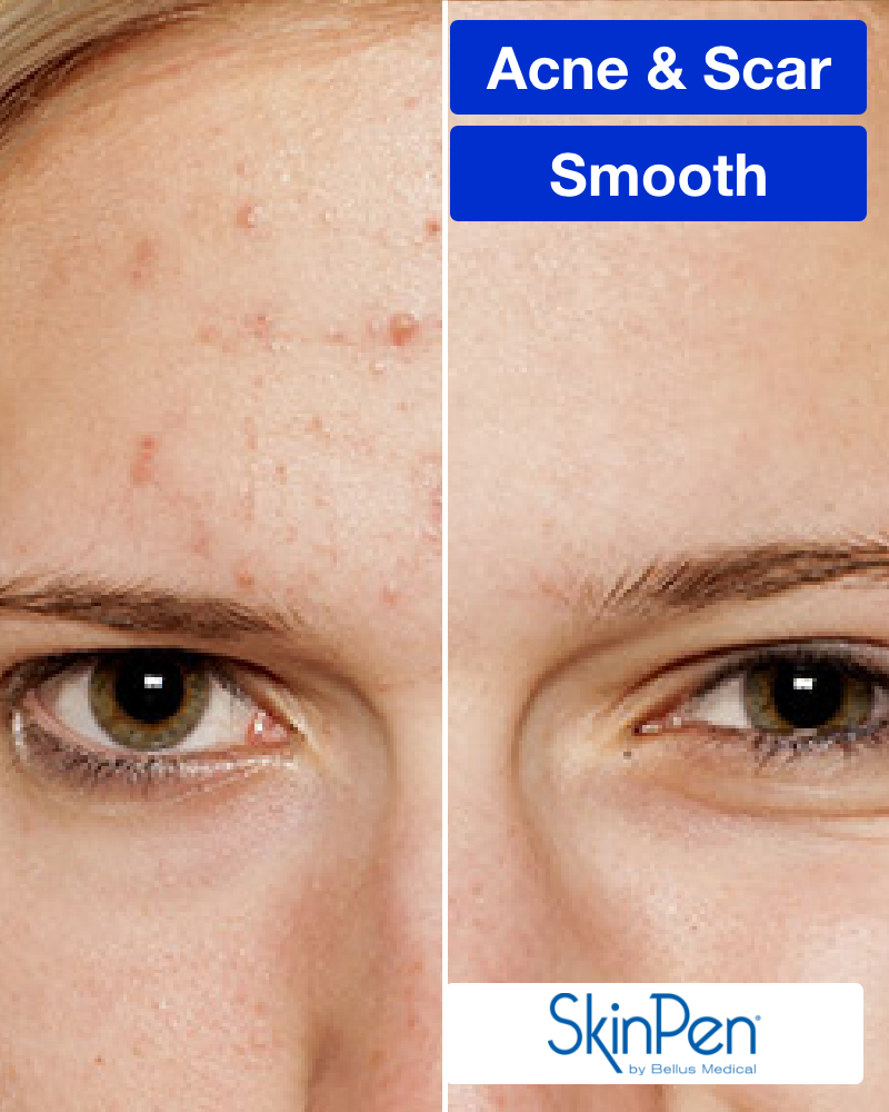 One (1) SkinPen Treatments (Full Face)