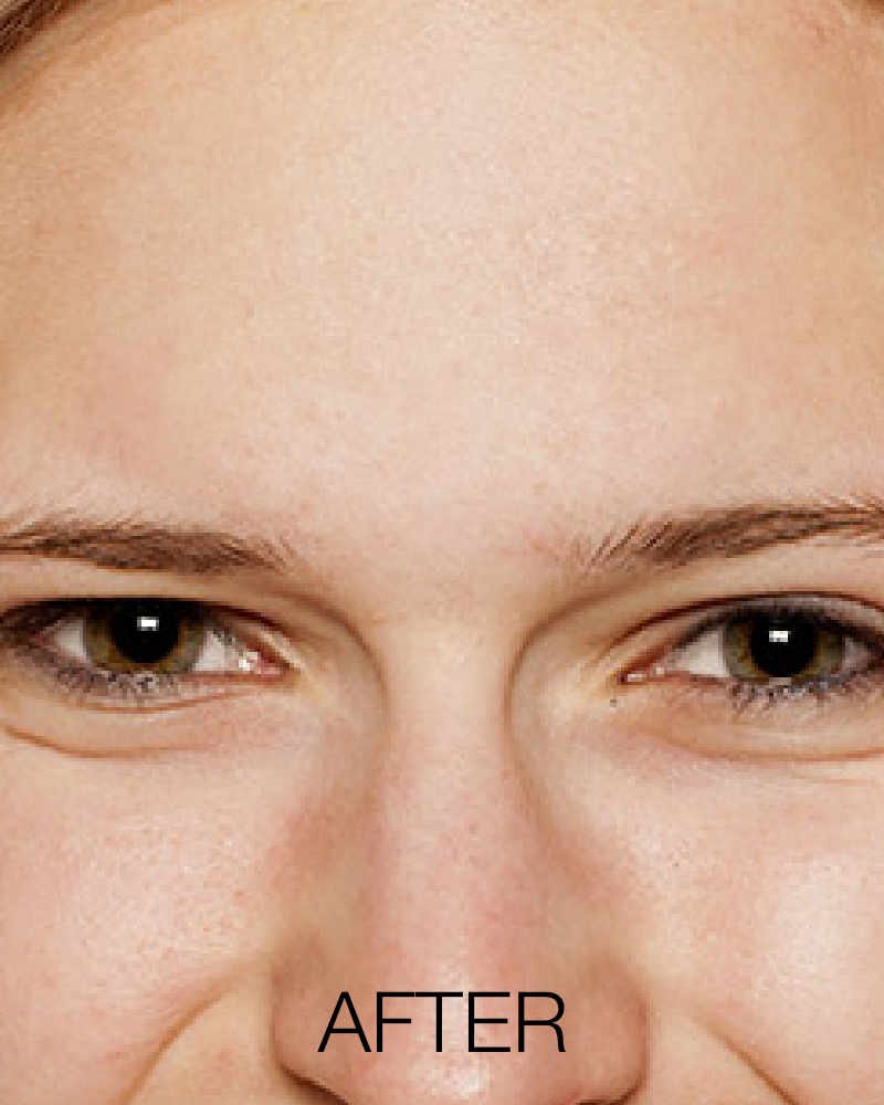 SkinPen – Full Face, Three (3) Sessions