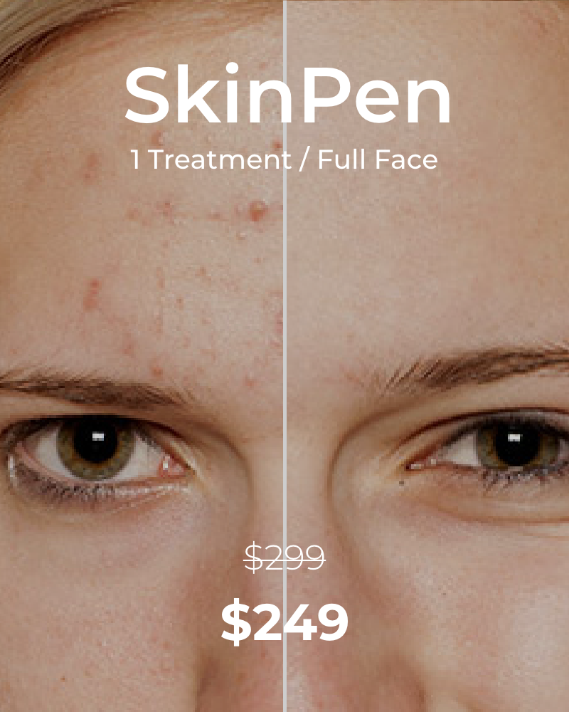 One (1) SkinPen Treatments (Full Face)