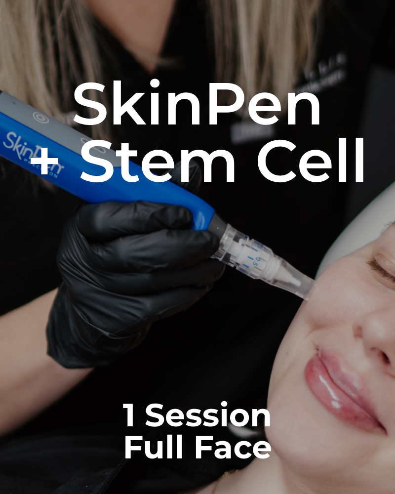One (1) Session of SkinPen + Stem Cell Treatment - Full Face