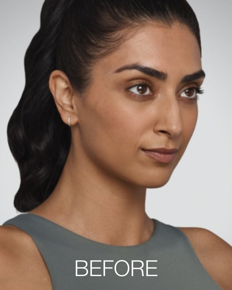 Service Voucher - Totally Flawless Package: Any 5 Syringes of Juvederm Dermal Filler + FREE One (1) Aesthetic Treatment