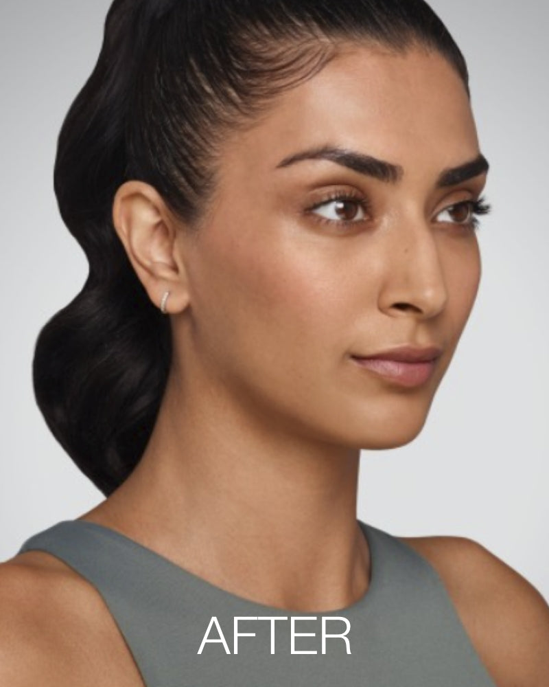 Service Voucher - Totally Flawless Package: Any 5 Syringes of Juvederm Dermal Filler + FREE One (1) Aesthetic Treatment