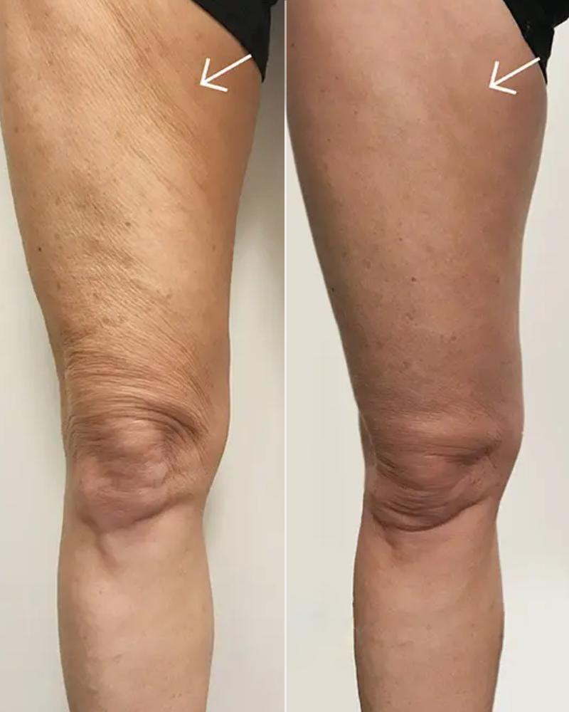 VelaShape® Body Contouring – One (1) Treatment