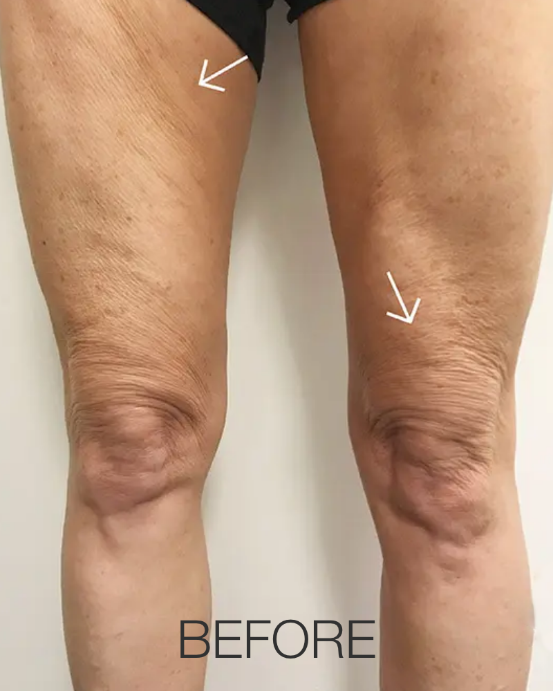 VelaShape® Body Contouring – One (1) Treatment
