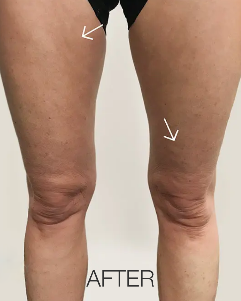 VelaShape® Body Contouring – One (1) Treatment